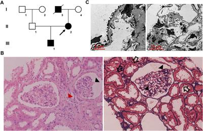 Novel heterozygous mutation in COL4A4 responsible for Alport syndrome in a Chinese family